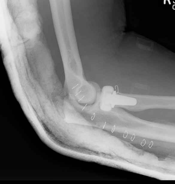 Radial Head Replacement Lateral